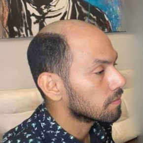 Cabelo humano para prótese capilar em Fortaleza, Prótese capilar feminina em Fortaleza, Cabelo humano para prótese capilar masculina, Melhores próteses capilares em Fortaleza, Prótese capilar masculina natural em Fortaleza